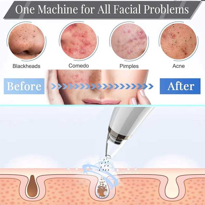 6-in-1%20Blackhead%20Remover%20USB%20Rechargeable%20%E2%80%93%20Derma%20Suction%20Acne%20&%20Blackhead%20Removal%20Machine%20with%20LED%20Display%20for%20Oily,%20Dry%20&%20Sensitive%20Skin%20-%20Image%202