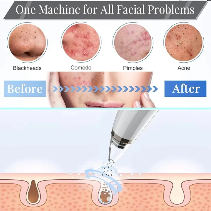 6-in-1%20Blackhead%20Remover%20USB%20Rechargeable%20%E2%80%93%20Derma%20Suction%20Acne%20&%20Blackhead%20Removal%20Machine%20with%20LED%20Display%20for%20Oily,%20Dry%20&%20Sensitive%20Skin%20-%20Image%202