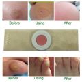 Foot & Hand Corn Removal Calluses Plantar Warts Thorn Pain Relief Plaster Effective. 