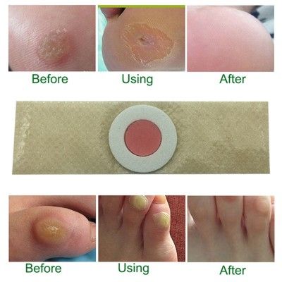 Foot%20&%20Hand%20Corn%20Removal%20Calluses%20Plantar%20Warts%20Thorn%20Pain%20Relief%20Plaster%20Effective%20-%20Image%205