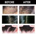 Scalp Care Roller Ball External Use Repair Skin Dandruff and Dandruff Deep Cleansing and Moisturizing Scalp Care Roller Ball. 