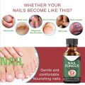 Fast Nail Fungal Treatments Nail Repair Essences Serum Care Treatments Foot Nail Fungus Removal Gel Paronychia Onychomycosis. 