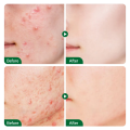 FORT Salicylic Acid Serum – Anti-Acne Face Serum & Dark Spot Correcting Serum for Glowing Skin | Acne Skin Care Products 30ml. 