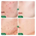 FORT Salicylic Acid Serum – Anti-Acne Face Serum & Dark Spot Correcting Serum for Glowing Skin | Acne Skin Care Products 30ml. 