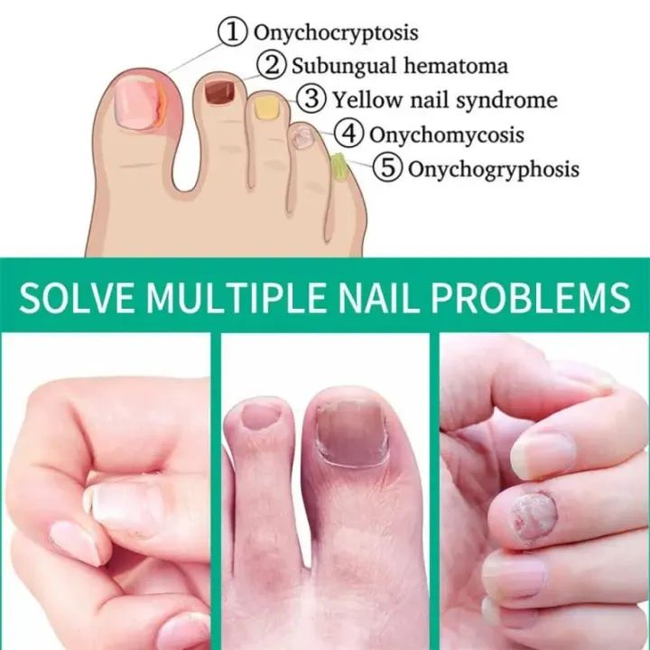 South%20Moon%20Premium%20Nail%20Fungus%20Treatment%20Serum%20-%20Effective%20Nail%20Repair%20&%20Protection%20for%20Onychomycosis%20-%20Image%206