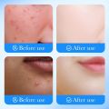 Sadoer Salicylic Acid Acne patch repair acne skin & promote healing Pimple Patch Invisible Pimple Patches for Clearer Skin SD09630. 