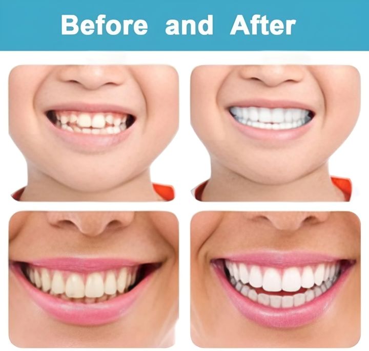 Snap-On%20Smile%20Instant%20Teeth%20Whitening%20Snap-On%20Cosmetic%20Denture%20for%20White%20Smile%20Oral%20Hygiene%20Accessory%20-%20Image%203