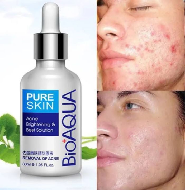New ACNE & PIMPLES REMOVAL CREAM, Acne Scar Mark Remover Removal Oil Control Shrink Pores Treatments Cream