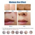 Profesional Laser Plasma Pen Skin Care Beauty Tool Black Dot Pore Skin Tag Blackhead Remover Warts Tattoo Removal Face Skin Care. 