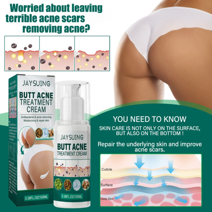 100ml Butt Acne Treatment Cream Clearing Buttock Thigh Acne Bumps Dark Spots Moisturizing Smoothing Hydrating Skin Care