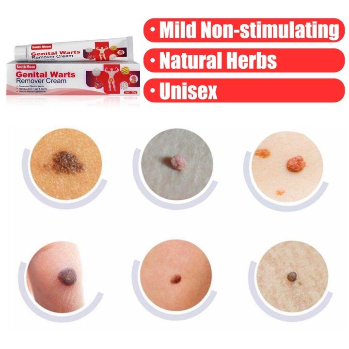 South%20Moon%20Wart%20Removing%20Ointment%20Anti%20Warts%20Ointment%20Hands%20Axillary%20Meat%20Particles%20Neck%20Filamentous%20Smooth%20Wart%20Remover%20Cream%20-%20Image%207