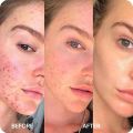 Fair & Clear Anti Acne Cream for both Male & Female. Get fast Glowing & Clearer Skin. BERG Cosmetics. 