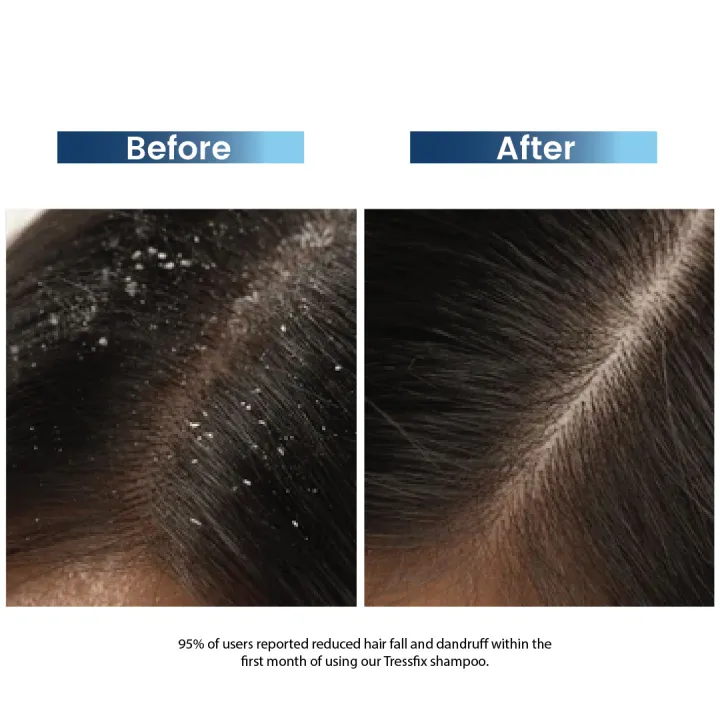 Rederm%20Tressfix%20Hairfall%20&%20Anti-Dandruff%20Shampoo%20-%20Image%205