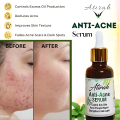 Atirah Anti-Acne Serum | Vitamin C + E | Oily Skin Control | Acne & Pimple Repair | Skin Strengthening & Hydration | Blemish-Free & Glowing Skin | 30ML. 