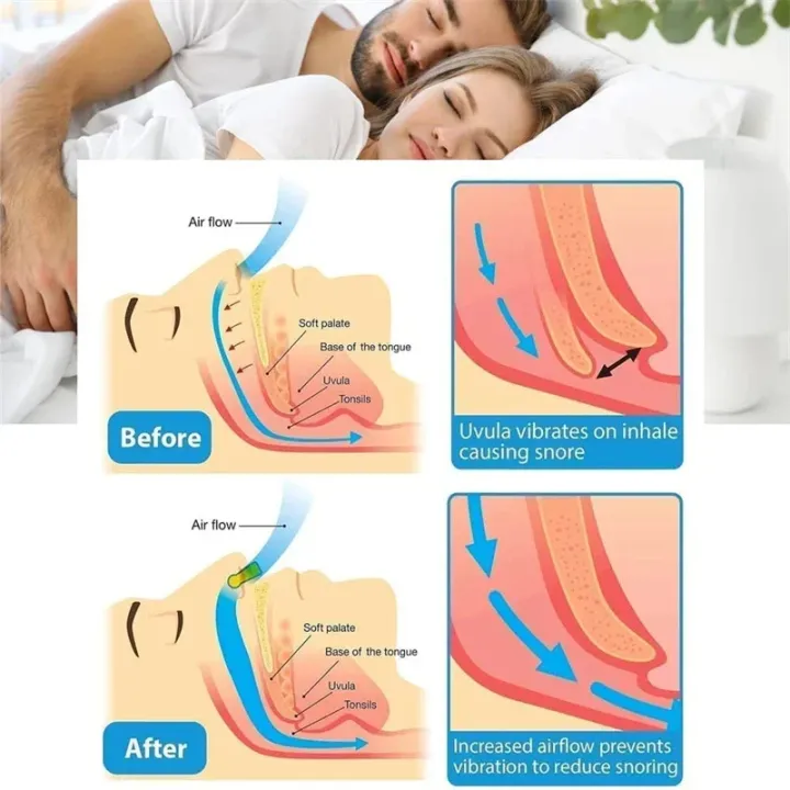 Snoring%20Solution,%20Magnetic%20Anti%20Snore%20Clip,%20Magnetic%20Nose%20Clip,%20Snore%20Stopper%20Silicone%20Nose%20Device,%20Comfortable%20&%20Professional%20Anti%20Snoring%20Devices%20for%20Peaceful%20Night%20-%20Image%204