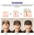 Derma Roller 0.5 Mm for Hair & Skin use. 