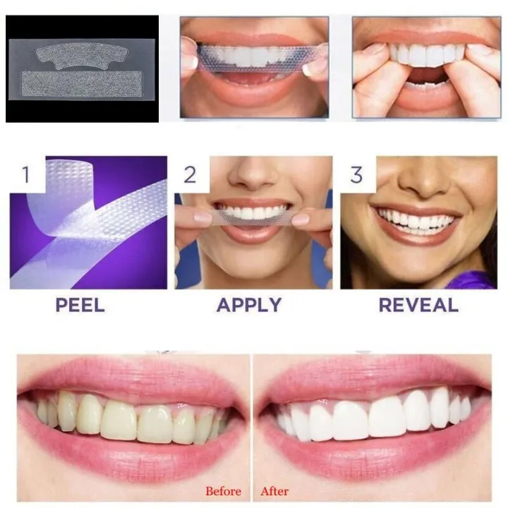 Advanced%20Teeth%20Whitening%20Strips%20%E2%80%93%20Dental%20Bleaching%20Tools%20for%20Oral%20Hygiene%20Care,%20Effectively%20Brighten%20and%20Whiten%20Your%20Teeth%20-%20Image%205