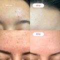 Salicylic Acid Serum (30ml) | Anti-acne | Acne Treatment. 