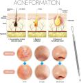 Dexam Blackhead Remover Loop Professional Blackhead & Whitehead Remover Tool for Blemish Comedone Pimple Popper with Double Sided Soft Touch and Anti-Slip Design. 