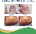 Royal Prestige Ingrown Toenail Pain Reliever Patches (30 Patches) — Fast Relief, Toenail Correction Sticker, Toe Nail Treatment Strips ingrown toenail patches toenail pain reliever toenail correction sticker toe nail treatment foot care patch. 