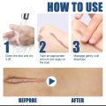 Scar Removal Cream Burn  Scar Treatment. 
