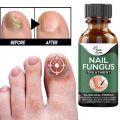 Fast Nail Fungal Treatments Nail Repair Essences Serum Care Treatments Foot Nail Fungus Removal Gel Paronychia Onychomycosis. 