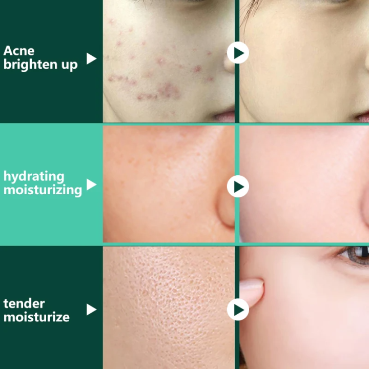 UPTOWN%20LA%20Anti%20Acne%20Cream%20%20for%20Acne%20Prone%20Skin%20and%20Acne%20Scars%20Marks%20with%20Niacinamide%20and%20Salicylic%20Acid%20%7C%20Anti%20Acne%20Face%20Treatment%20for%20Dark%20Spots%20%7C%2030%20ml%20-%20Image%202