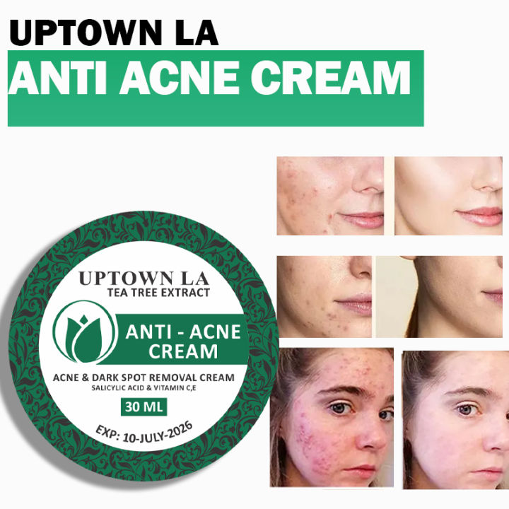 UPTOWN%20LA%20Anti%20Acne%20Cream%20%20for%20Acne%20Prone%20Skin%20and%20Acne%20Scars%20Marks%20with%20Niacinamide%20and%20Salicylic%20Acid%20%7C%20Anti%20Acne%20Face%20Treatment%20for%20Dark%20Spots%20%7C%2030%20ml%20-%20Image%206