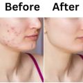 No Side Effect Guaranteed Results Cream for Face - Safe For All Skin Types With Perfect Whitening. 