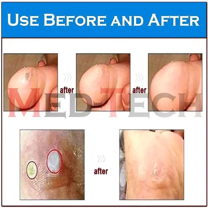 CORN%20CAP%20(Foot%20Care)%20PACK%20OF%205%20-%20Image%204