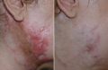 Timilk RegenScar Cream | Advanced Scar Removal Cream | Acne Marks, Stretch Marks & Dark Spots Treatment | Skin Repair Formula. 