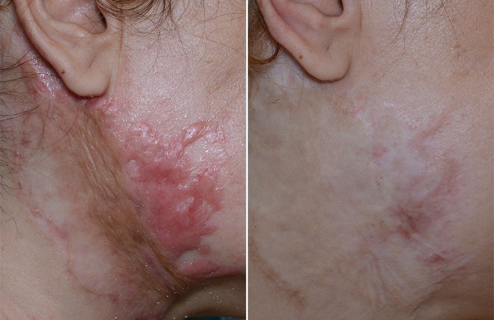 Timilk%20RegenScar%20Cream%20%7C%20Advanced%20Scar%20Removal%20Cream%20%7C%20Acne%20Marks,%20Stretch%20Marks%20&%20Dark%20Spots%20Treatment%20%7C%20Skin%20Repair%20Formula%20-%20Image%206