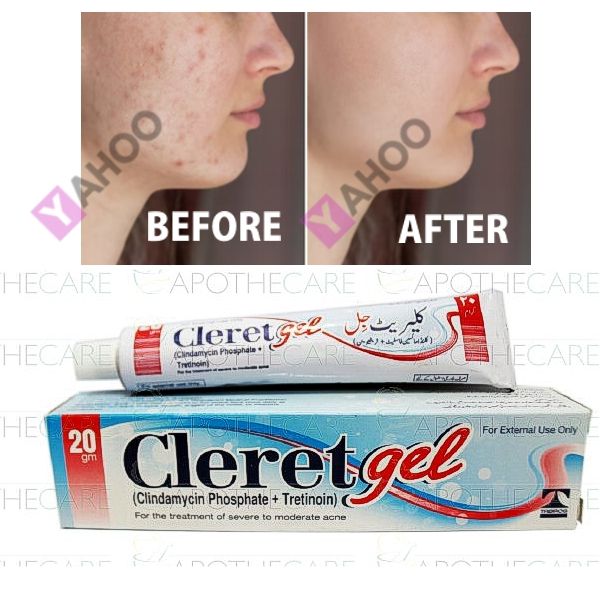 CLERET GEL (Clindamycin Phosphate 1% + Tretinoin 0.025%) 20gm Dual-Action Prescription Acne Treatment