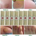 Foot & Hand Corn Removal Calluses Plantar Warts Thorn Pain Relief Plaster Effective. 