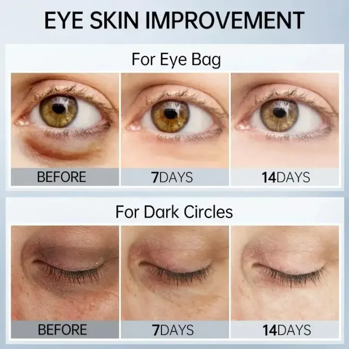 FORT%20Under%20Eye%20Gel%20Remove%20Dark%20Circles%20Fades%20Fine%20Lines%20Eye%20Bag%20Puffiness%20Anti-aging%20Tighten%20Anti%20Wrinkle%20Whiten%20Under%20Eyes%20Care%203oml%20-%20Image%205