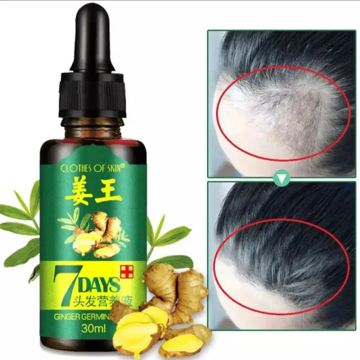 Ginger%20Germinal%20Oil%20For%20Hair%20Growth%20%7C%207%20Days%20%7C%20Guaranteed%20Results%20%7C%20Fatest%20Hair%20Growth%20&%20Care%20%7C%20For%20Boys%20&%20Girls%20-%20Image%205