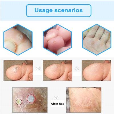 Foot%20&%20Hand%20Corn%20Removal%20Calluses%20Plantar%20Warts%20Thorn%20Pain%20Relief%20Plaster%20Effective%20-%20Image%204