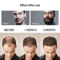 Derma Roller Hair Regrowth Beard Growth Anti Hair Loss Treatment Thinning. 