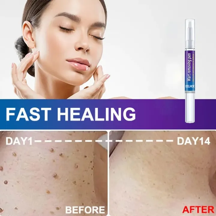 Skin%20Tag%20eye%20Wart%20Mole%20Remover%20Pen%20Woman%20Skin%20Care%20Removing%20Against%20Moles%20Pimple%20Patch%20Remove%20Black%20Dot%20FLAIREX%20-%20Image%206