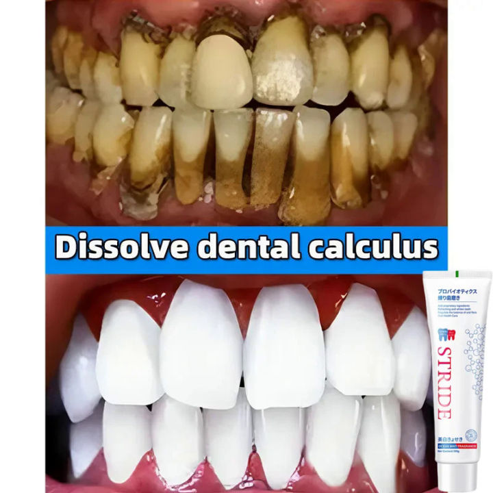 100ml Removing Dental Calculus Toothpaste Whitening Preventing Bad Breath Periodontitis Teethpaste Brightening Oral Cleaning