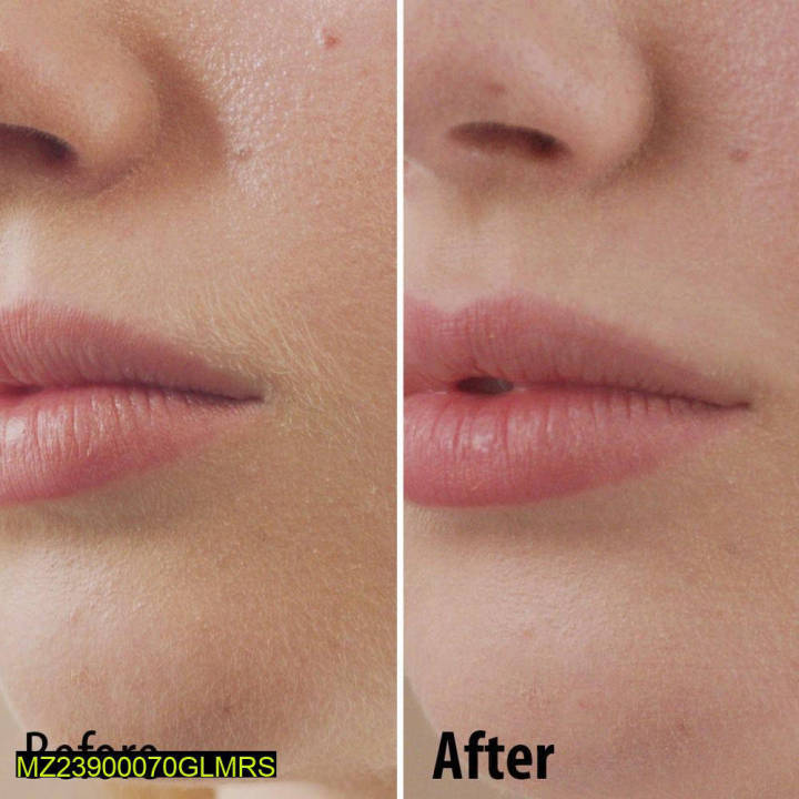 Facial%20Hair%20Removel%20Machine%20-%20Image%204