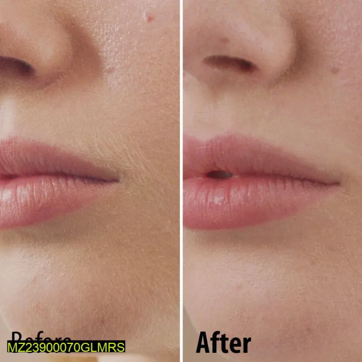 Facial%20Hair%20Removel%20Machine%20-%20Image%204